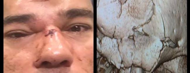 Evangelista Santos ondergaat operatie van 7 uur